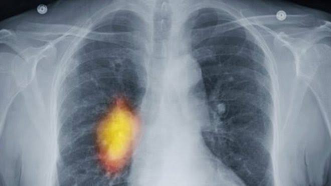 Women’s Lung Cancer Rates In The UK Expected To Surpass Men’s For the First Time